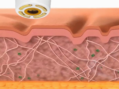 Tattoo Removal